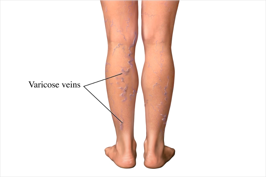 Varicose Veins and Leg Pain