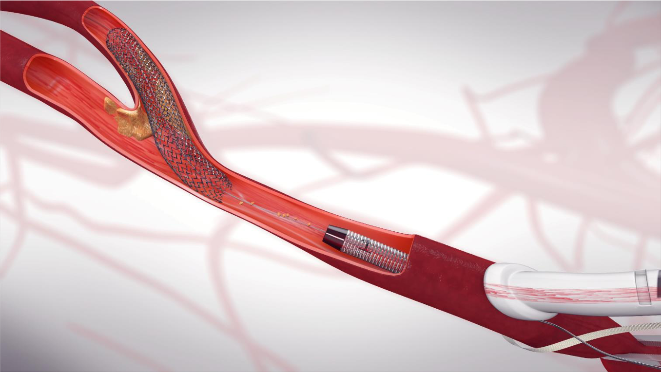 NEW carotid stenting better than old