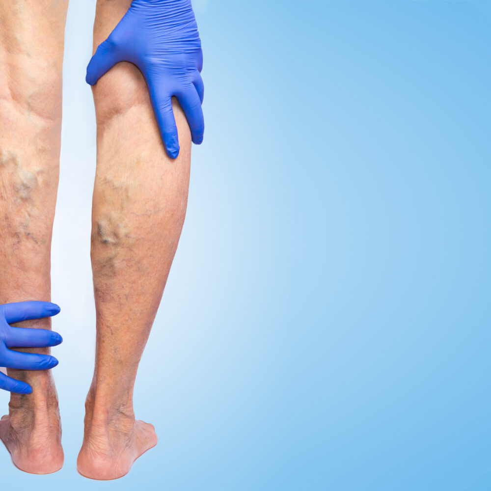 varicose-veins-snake-river-vascular-surgery