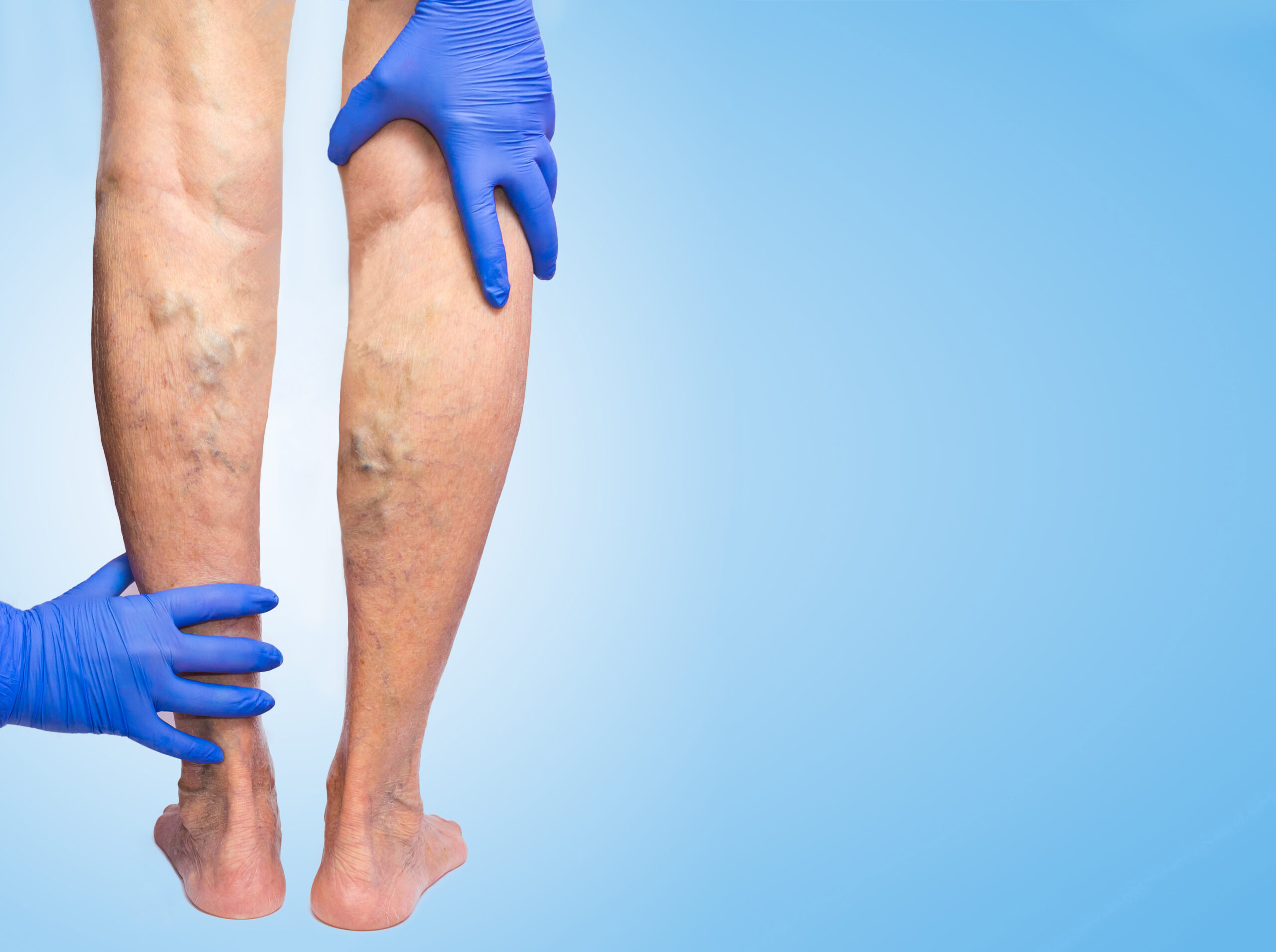 What is a Vein Ablation Procedure?