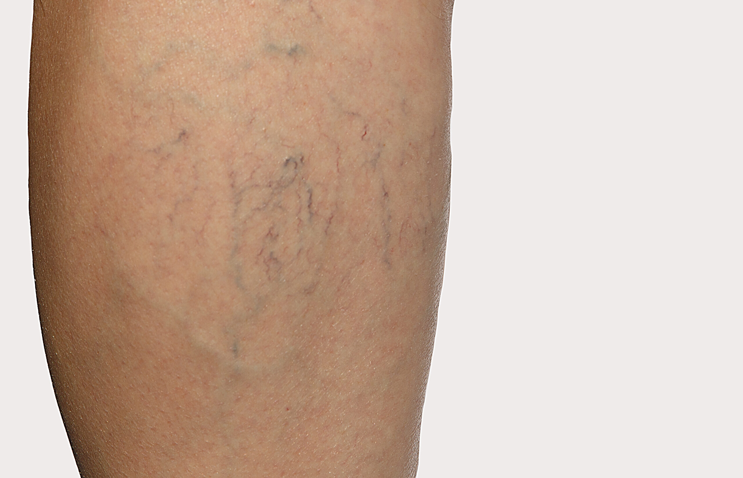 Difference Between Spider Veins and Varicose Veins